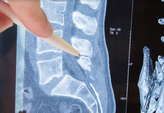 Can Regenerative Medicine Help Spinal Stenosis?