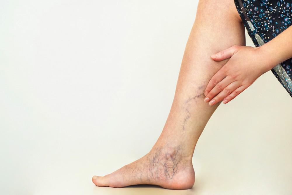 Finding the Best Vein Specialist to Deal with Varicose Veins