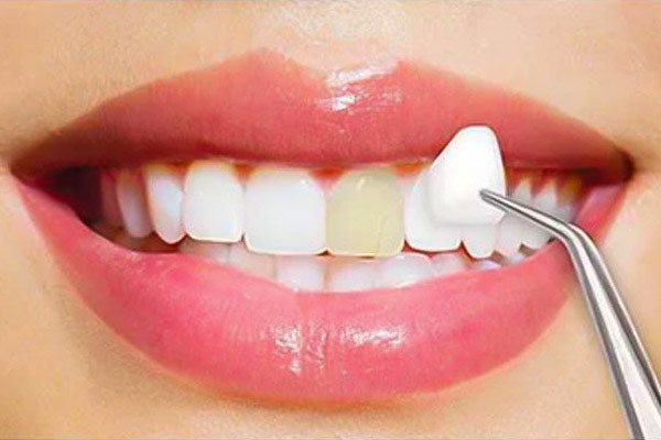 The 101-guide to dental veneers: Get that perfect smile