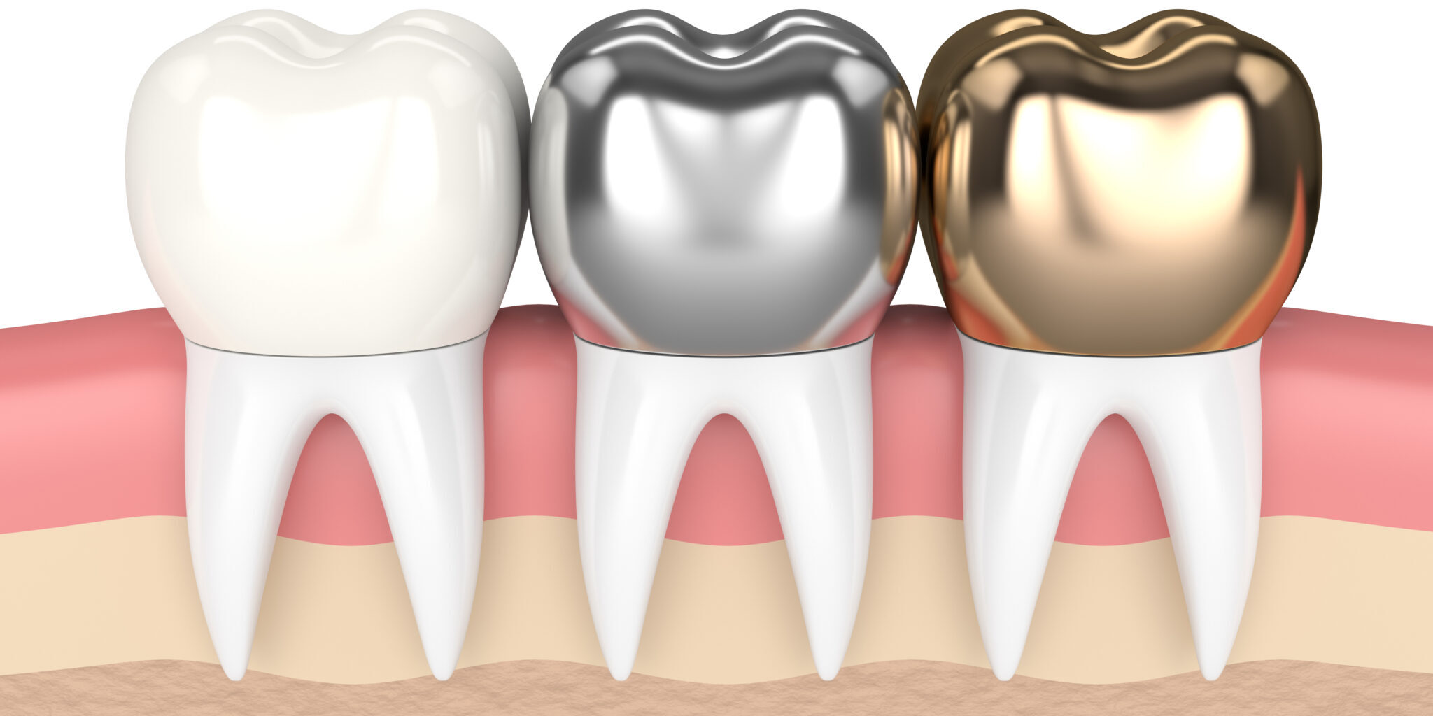 What Are Some Things About The Same Dental Crowns You May Not Know?