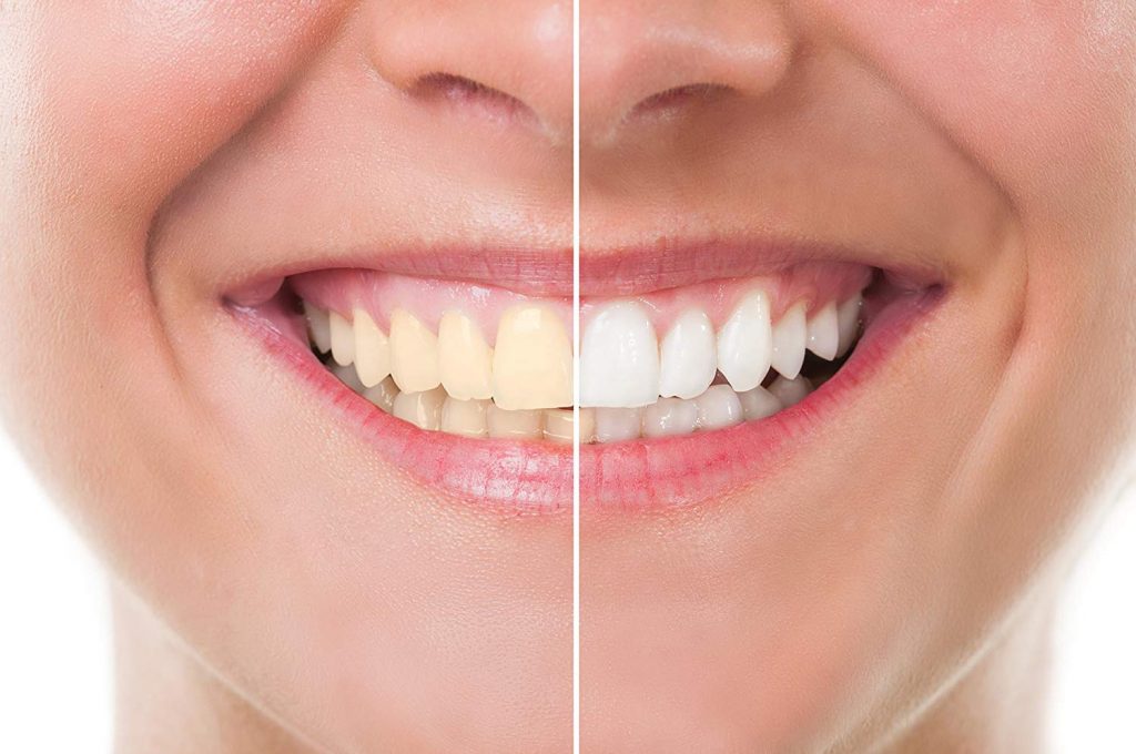 Is it Better to go For Teeth Whitening or Veneers?