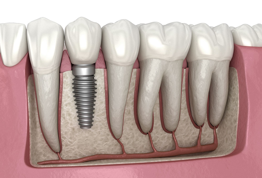 Dental implants have seven major advantages.