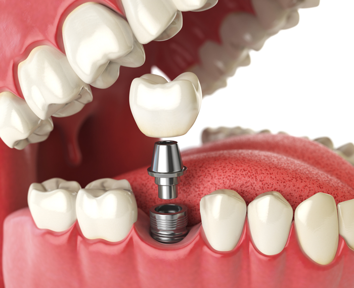 Why or why not get dental implants?