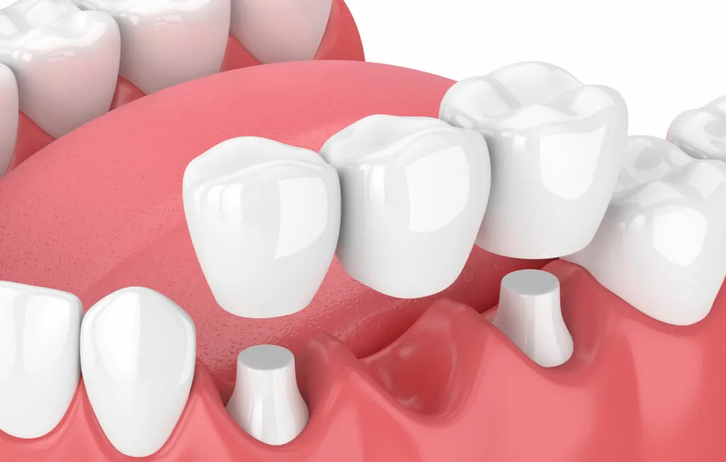 Differentiating Between the Four Common Dental Bridge Options