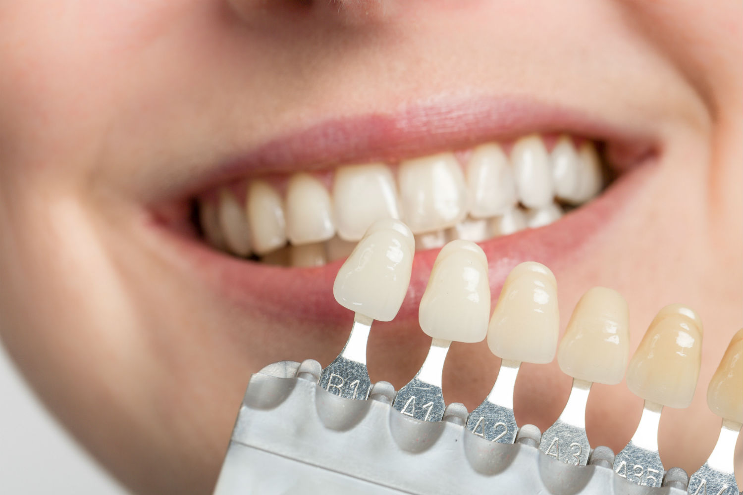 Porcelain Veneers vs. Dental Bonding: Which is Right for You? Insights from Our Fairfield Practice