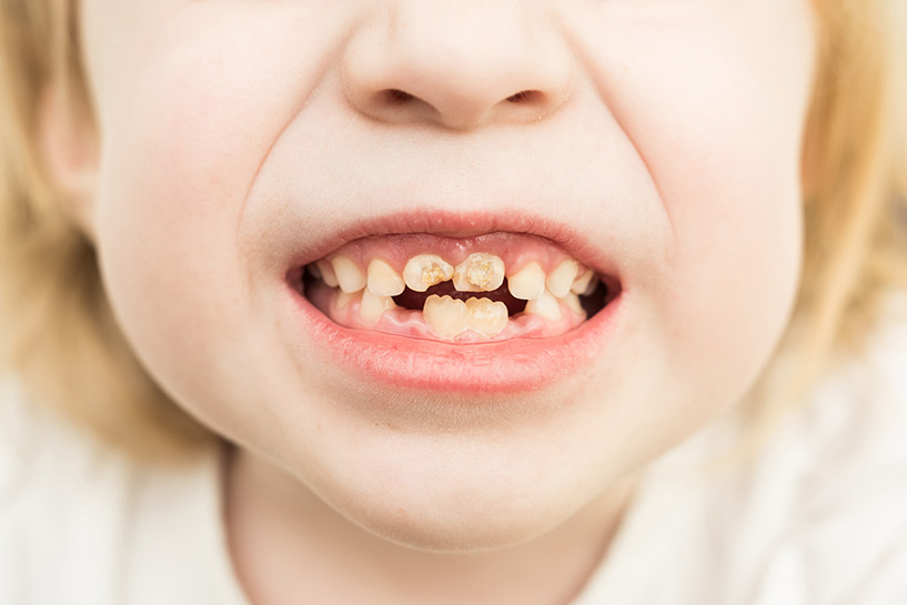 What is Baby Bottle Tooth Decay?