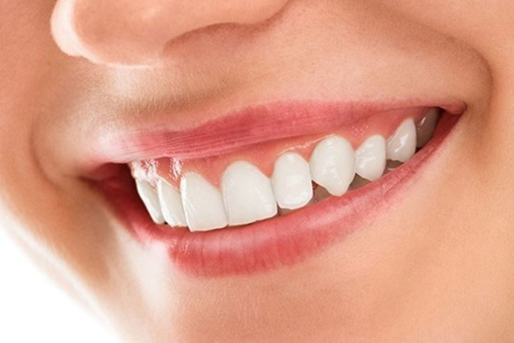 When To Consider Complete Smile Makeover? 