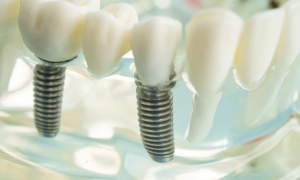 5 Ways All-on-X Differs From Traditional Dentures: A Comparison From Stubbs Dental and Other Utah Providers